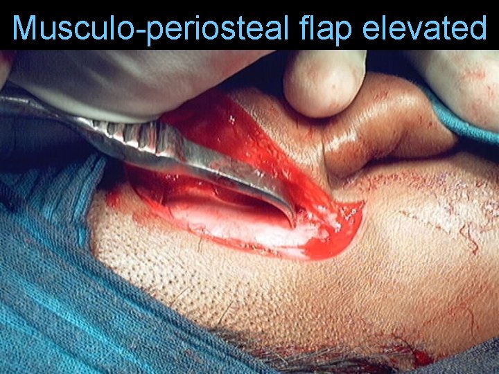 Musculo-periosteal flap elevated Musculo-periosteal flap elevated
