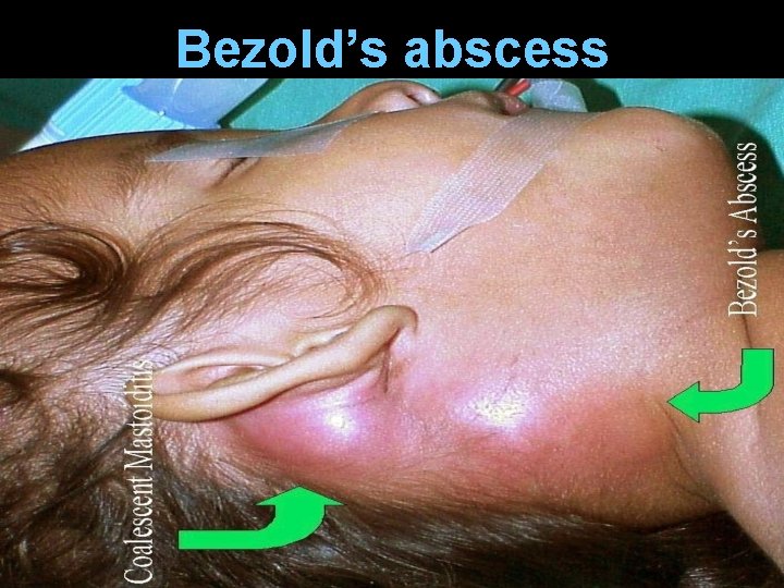 Bezold’s abscess Bezold’s abscess