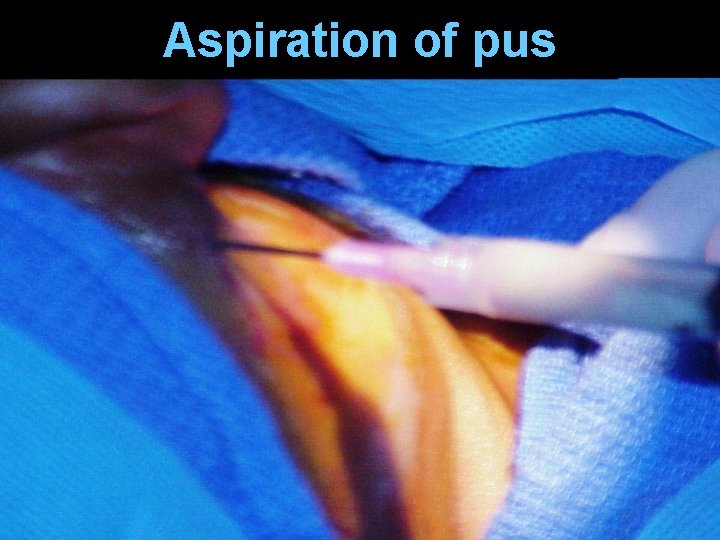 Aspiration of pus Aspiration of pus