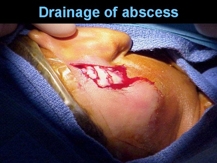 Drainage of abscess Drainage of abscess