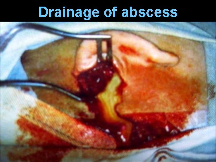 Drainage of abscess Drainage of abscess
