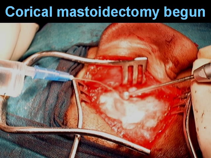 Corical mastoidectomy begun Corical mastoidectomy begun