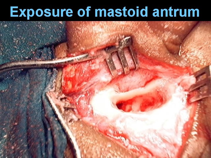 Exposure of mastoid antrum Exposure of mastoid antrum