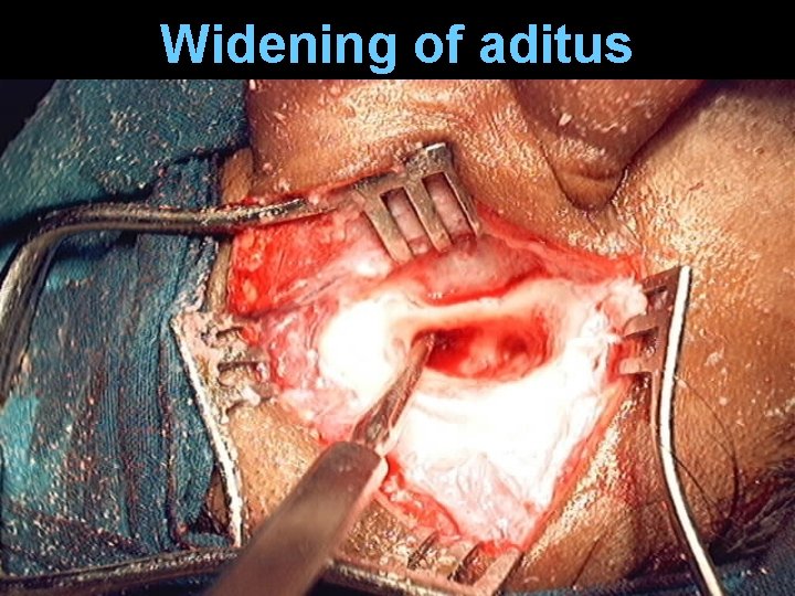 Widening of aditus Widening of aditus