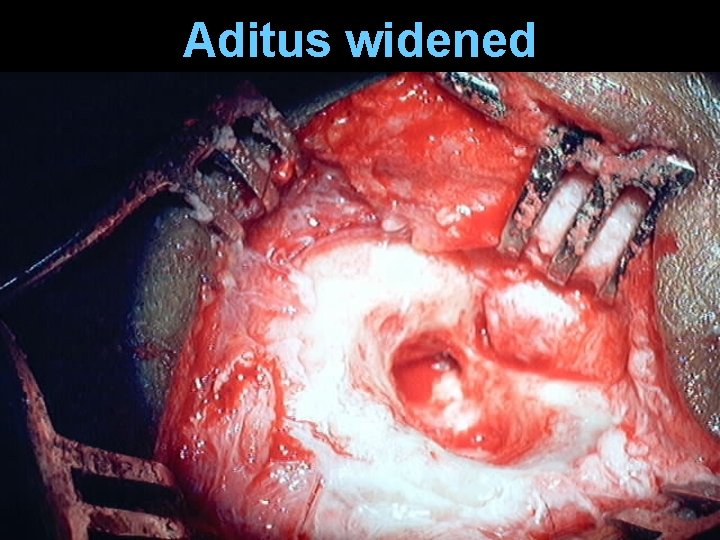 Aditus widened Aditus widened