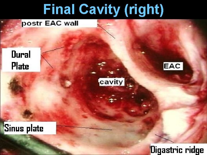 Final Cavity (right) Final Cavity (right)