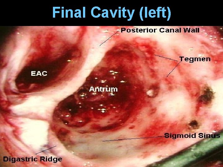 Final Cavity (left) Final Cavity (left)
