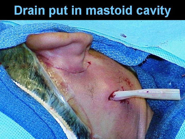 Drain put in mastoid cavity Drain put in mastoid cavity