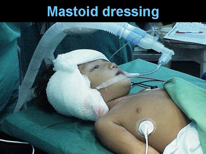 Mastoid dressing Mastoid dressing
