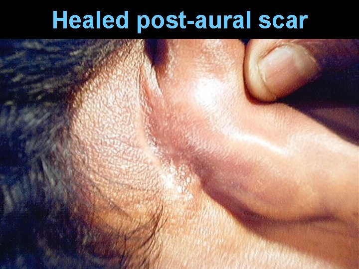 Healed post-aural scar Healed post-aural scar