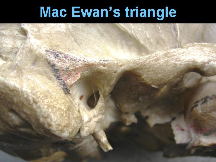 Mac Ewan’s triangle Mac Ewan’s triangle