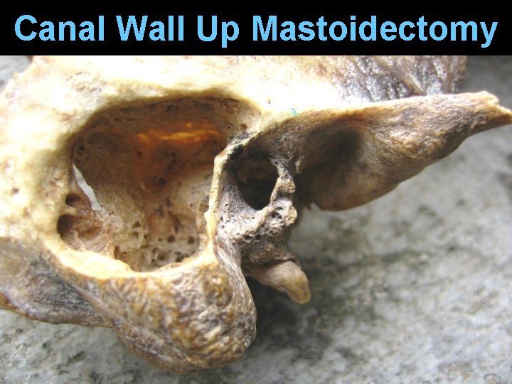 Canal Wall Up Mastoidectomy Canal Wall Up Mastoidectomy