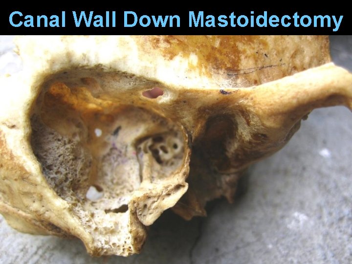 Canal Wall Down Mastoidectomy Canal Wall Down Mastoidectomy