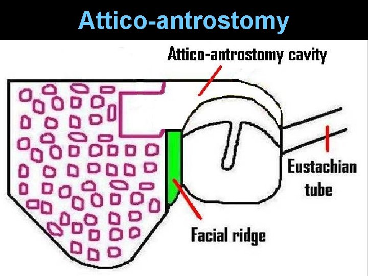 Attico-antrostomy Attico-antrostomy