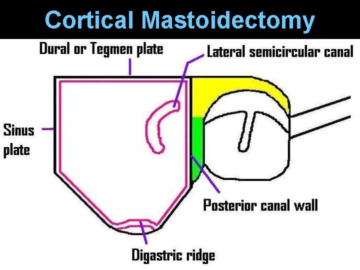 Cortical Mastoidectomy Cortical Mastoidectomy