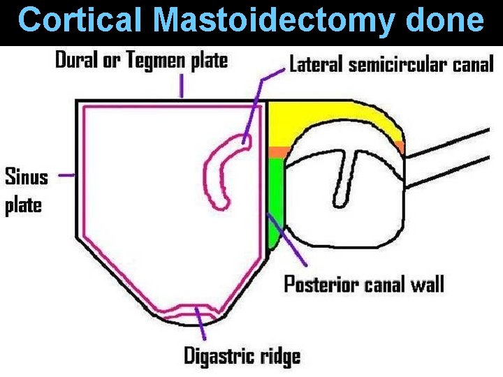 Cortical Mastoidectomy done Cortical Mastoidectomy done