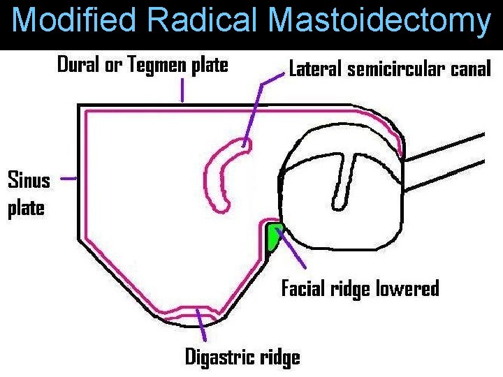 Modified Radical Mastoidectomy Modified Radical Mastoidectomy