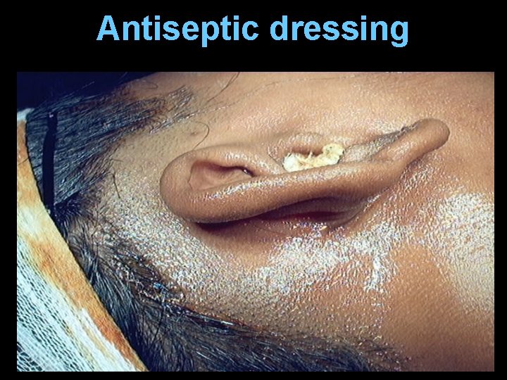 Antiseptic dressing Antiseptic dressing