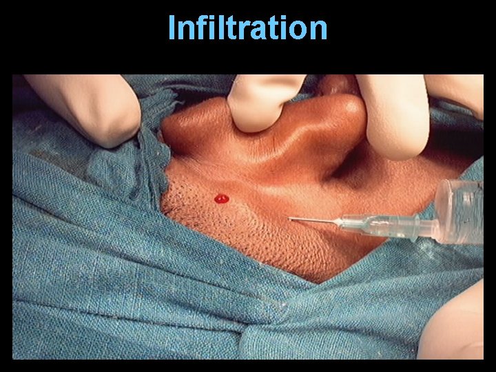 Infiltration Infiltration
