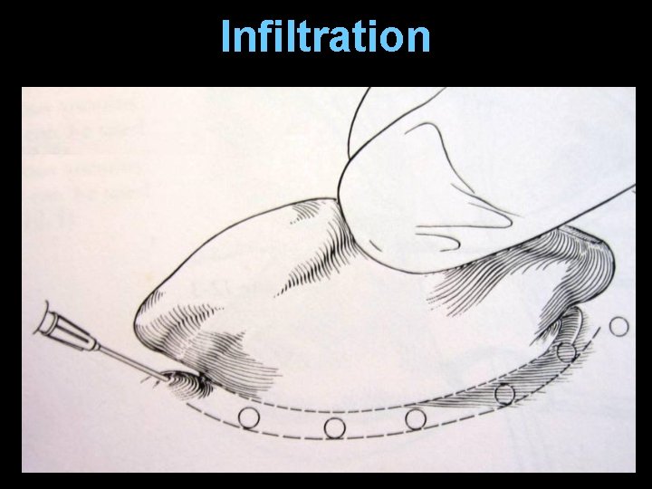 Infiltration Infiltration