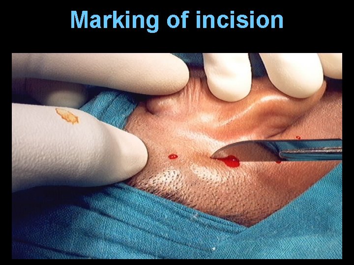 Marking of incision Marking of incision