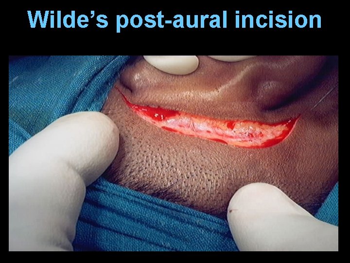 Wilde’s post-aural incision Wilde’s post-aural incision