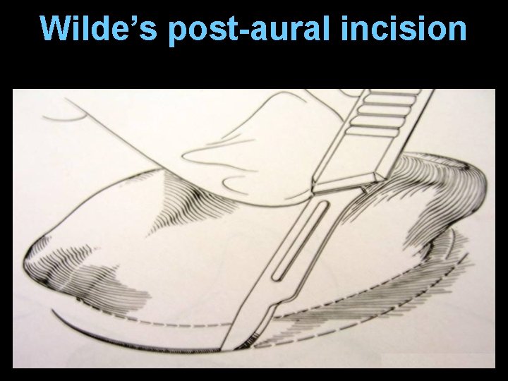 Wilde’s post-aural incision Wilde’s post-aural incision