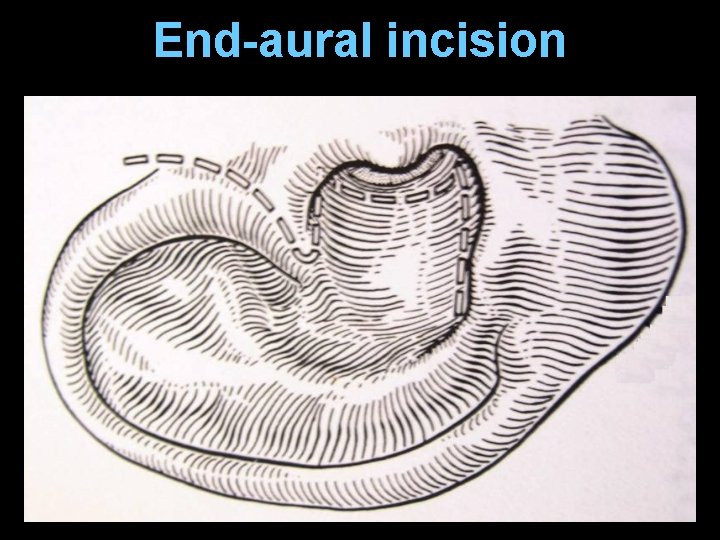 End-aural incision End-aural incision