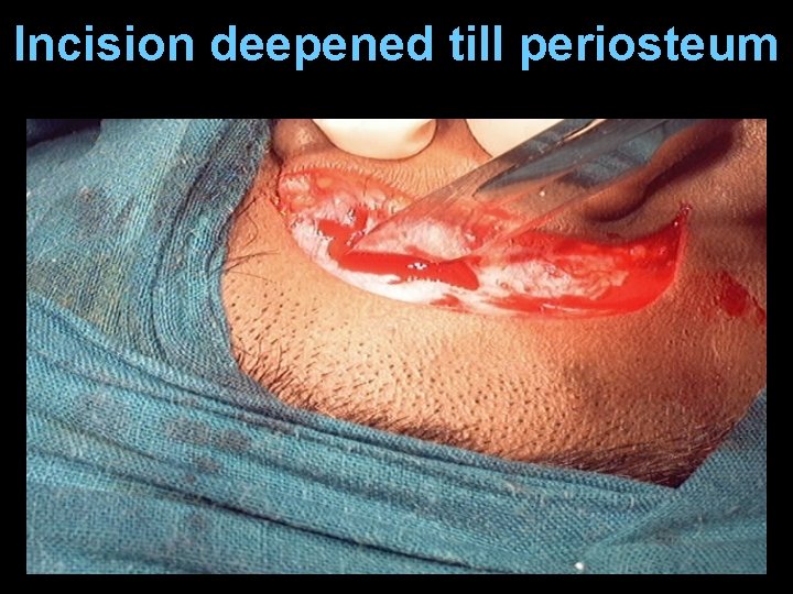 Incision deepened till periosteum Incision deepened till periosteum