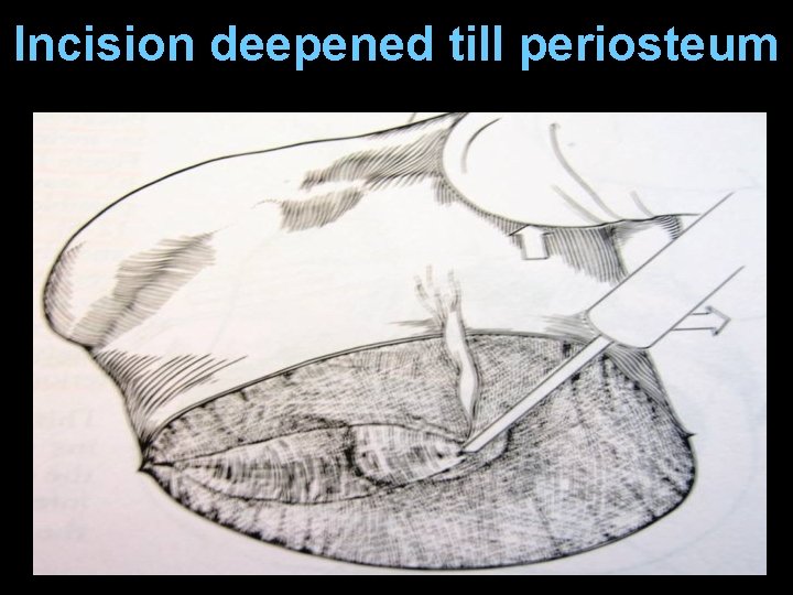 Incision deepened till periosteum Incision deepened till periosteum