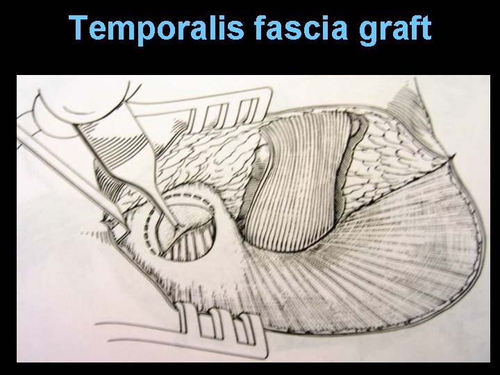Temporalis fascia graft Temporalis fascia graft