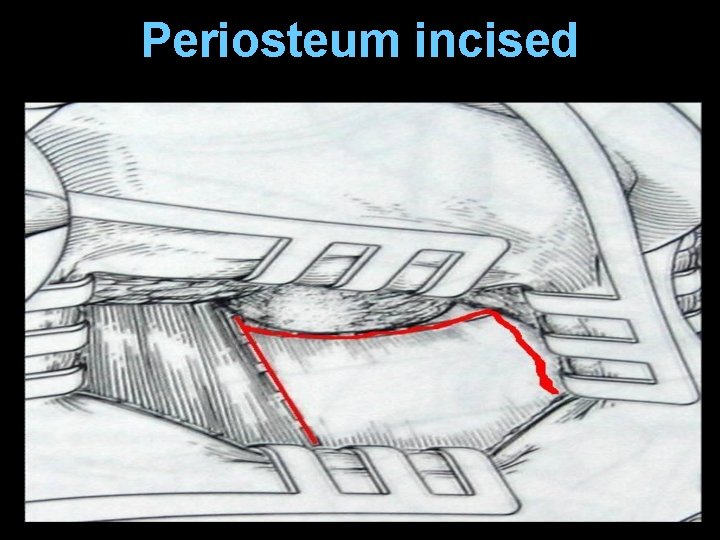 Periosteum incised Periosteum incised