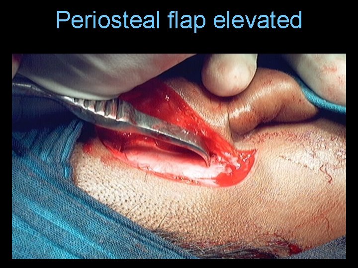 Periosteal flap elevated Periosteal flap elevated