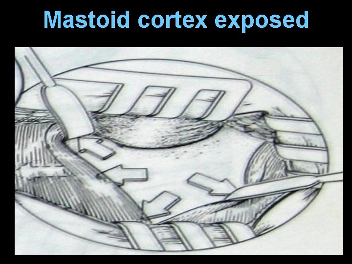 Mastoid cortex exposed Mastoid cortex exposed