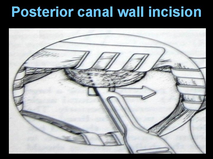 Posterior canal wall incision Posterior canal wall incision