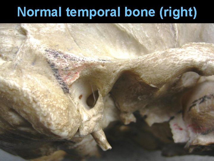 Normal temporal bone (right) Normal temporal bone (right)
