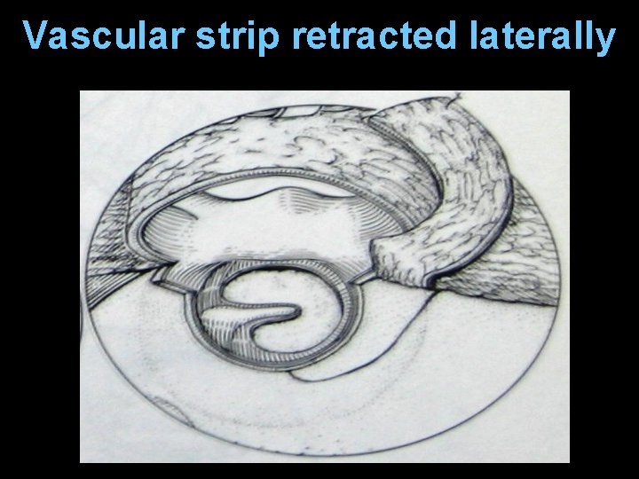 Vascular strip retracted laterally Vascular strip retracted laterally