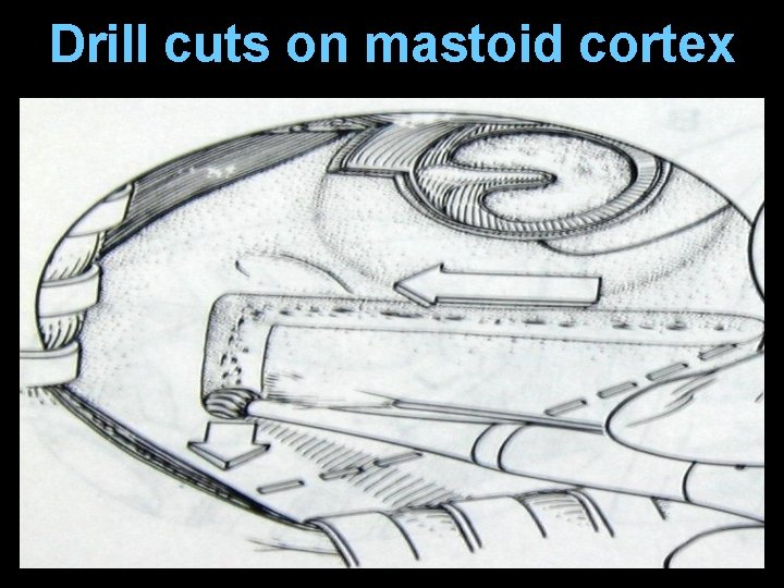 Drill cuts on mastoid cortex Drill cuts on mastoid cortex
