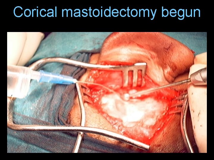Corical mastoidectomy begun Corical mastoidectomy begun