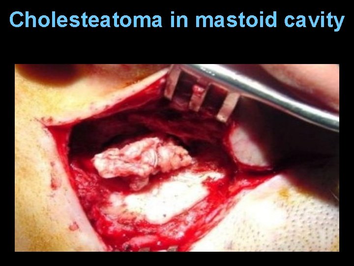 Cholesteatoma in mastoid cavity Cholesteatoma in mastoid cavity