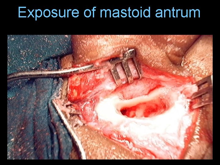 Exposure of mastoid antrum Exposure of mastoid antrum