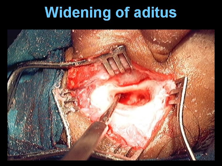 Widening of aditus Widening of aditus