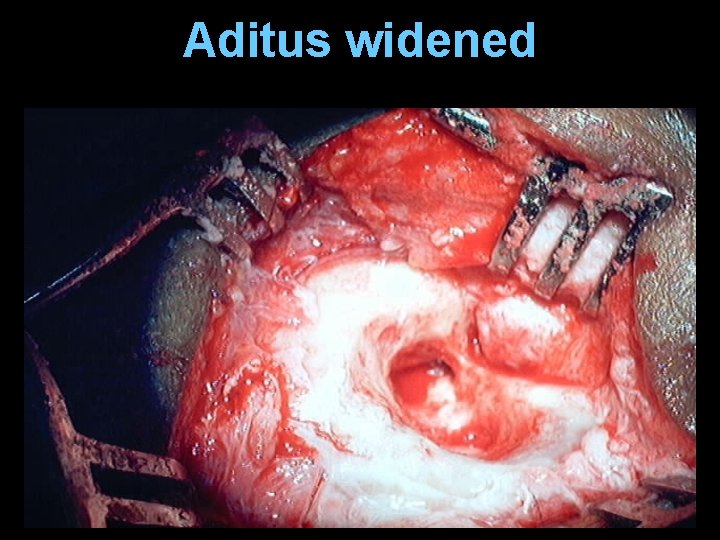 Aditus widened Aditus widened