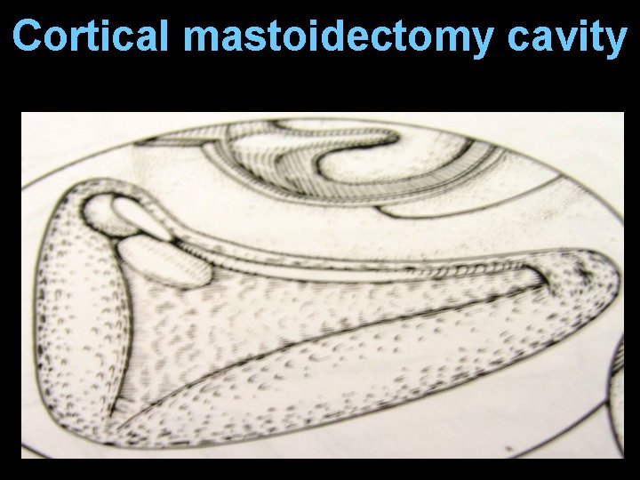 Cortical mastoidectomy cavity Cortical mastoidectomy cavity