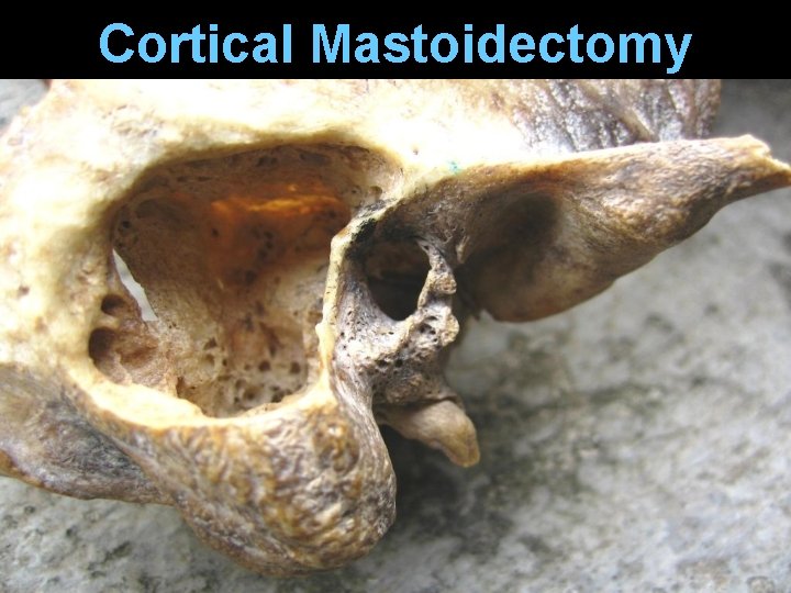 Cortical Mastoidectomy Cortical Mastoidectomy