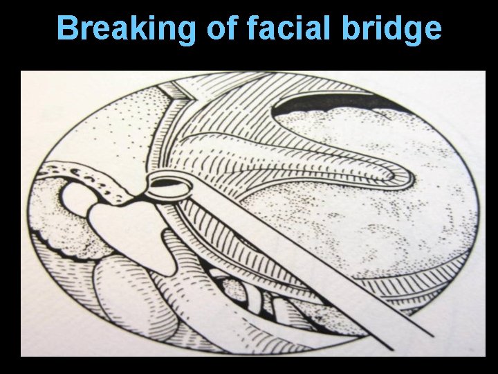Breaking of facial bridge Breaking of facial bridge