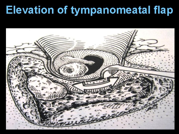 Elevation of tympanomeatal flap Elevation of tympanomeatal flap