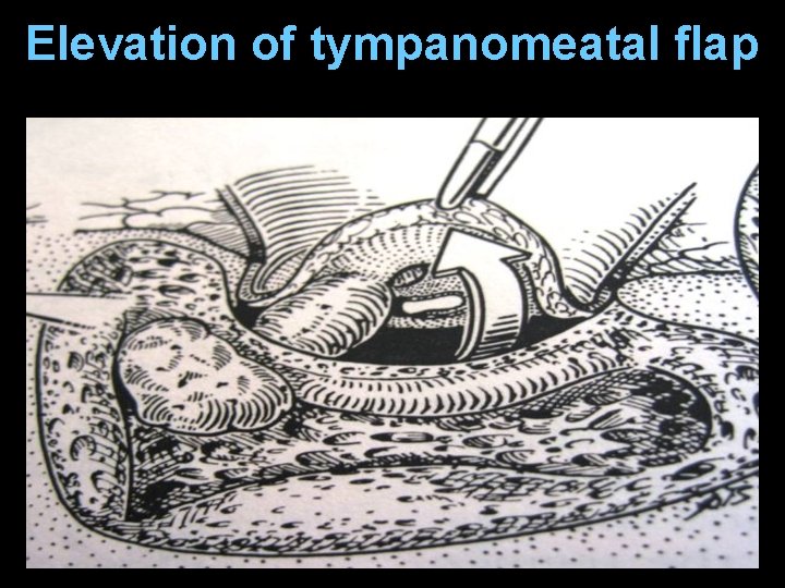 Elevation of tympanomeatal flap Elevation of tympanomeatal flap