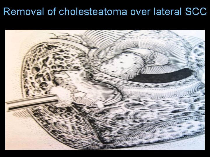 Removal of cholesteatoma over lateral SCC Removal of cholesteatoma over lateral SCC