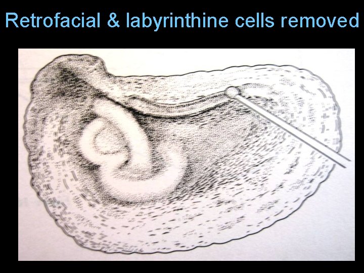 Retrofacial & labyrinthine cells removed Retrofacial & labyrinthine cells removed